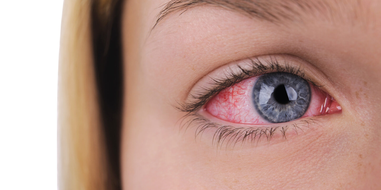 Geplatzte Ader im Auge: