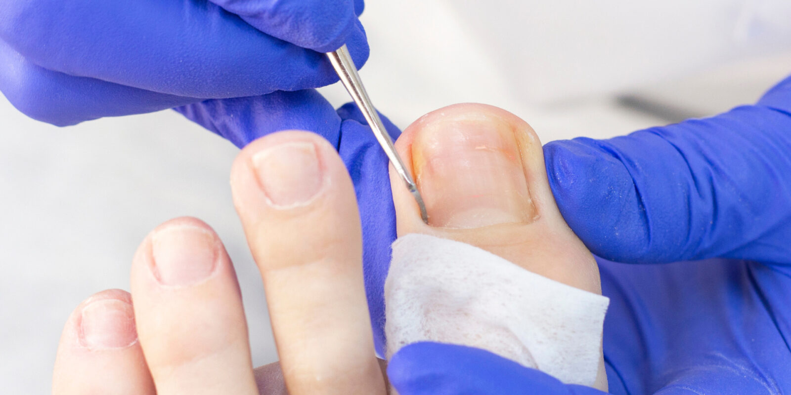 Nagelbettentzündung am Zeh: Symptome, Ursachen und Behandlung einer Entzündung am Zeh