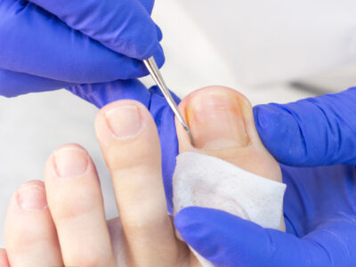 Nagelbettentzündung am Zeh: Symptome, Ursachen und Behandlung einer Entzündung am Zeh