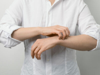 Wie behandle ich Krätze: Hausmittel Gegen Symptome und Ansteckung