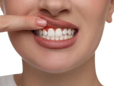 Was hilft gegen Zahnfleischentzündung: Welche Hausmittel helfen?