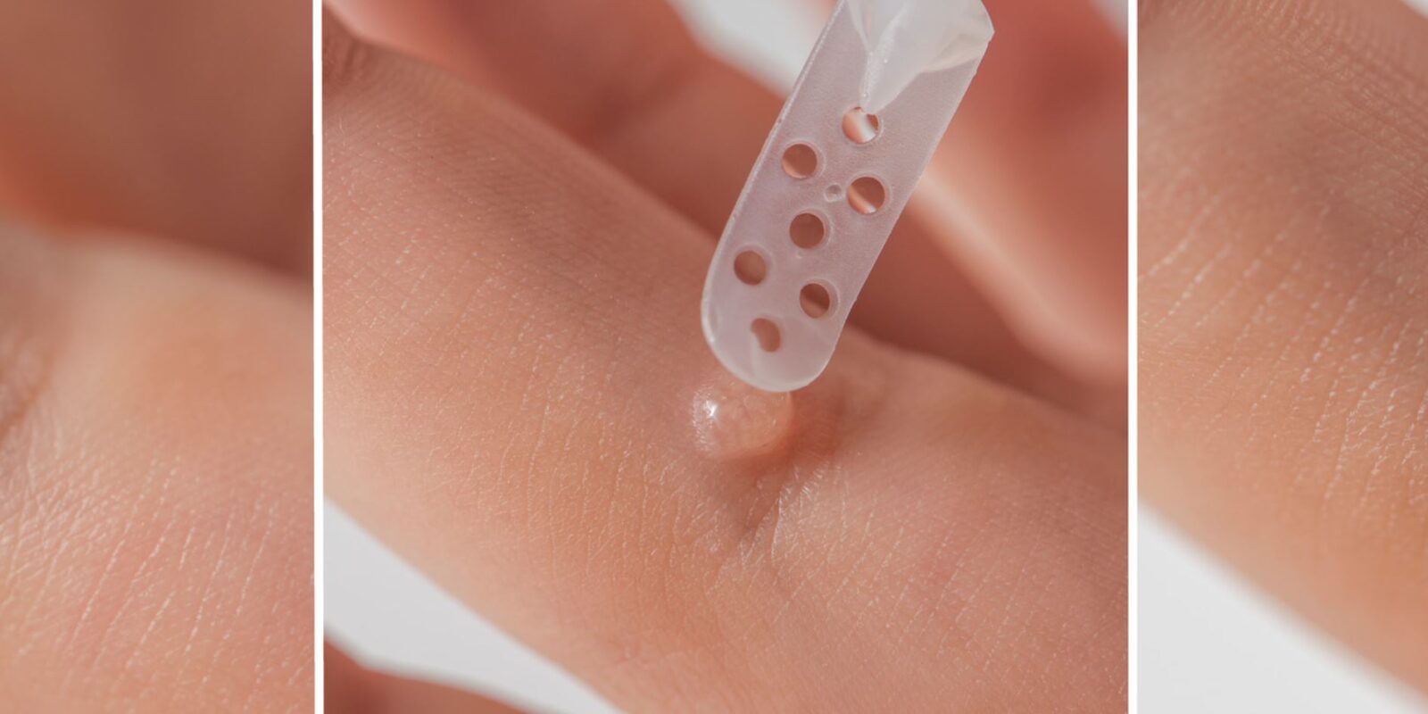 Warzen entfernen Warzen weg in 3 Tagen durch Hausmittel