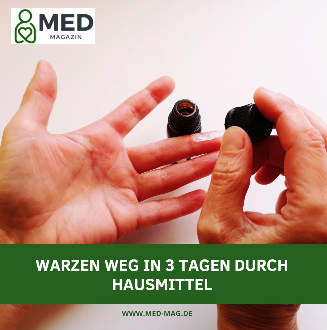 Warzen weg in 3 Tagen durch Hausmittel Was hilft wirklich Warzen weg in 3 Tagen durch Hausmittel Was hilft wirklich