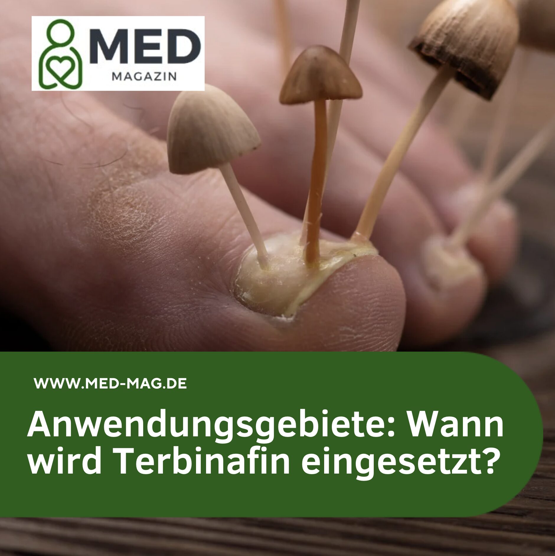 Anwendungsgebiete: Wann wird Terbinafin eingesetzt? Anwendungsgebiete: Wann wird Terbinafin eingesetzt?