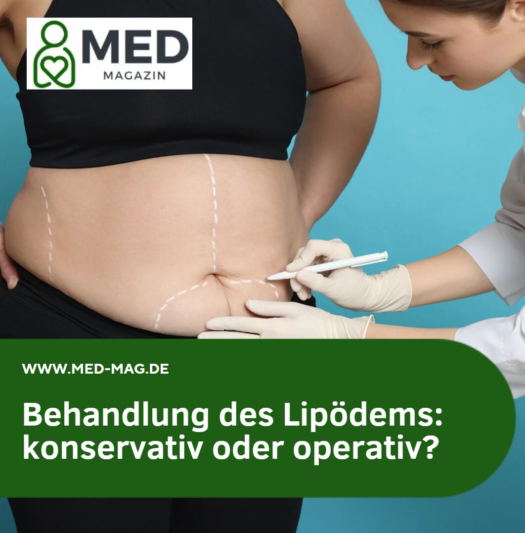 Behandlung des Lipödems konservativ oder operativ