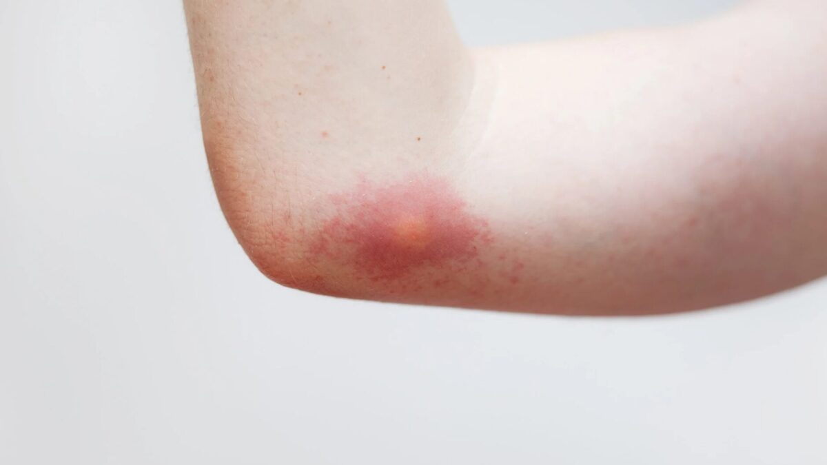 Bienenstich was tun Erste Hilfe bei Schmerzen, Schwellung und Allergie