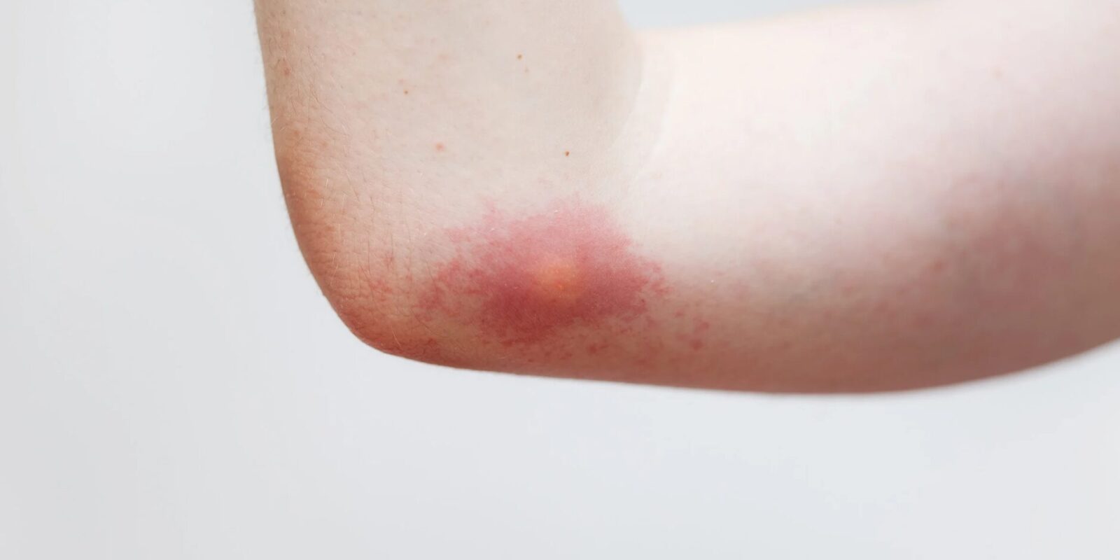 Bienenstich was tun Erste Hilfe bei Schmerzen, Schwellung und Allergie