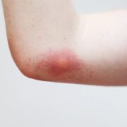 Bienenstich was tun Erste Hilfe bei Schmerzen, Schwellung und Allergie