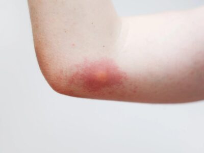 Bienenstich was tun Erste Hilfe bei Schmerzen, Schwellung und Allergie