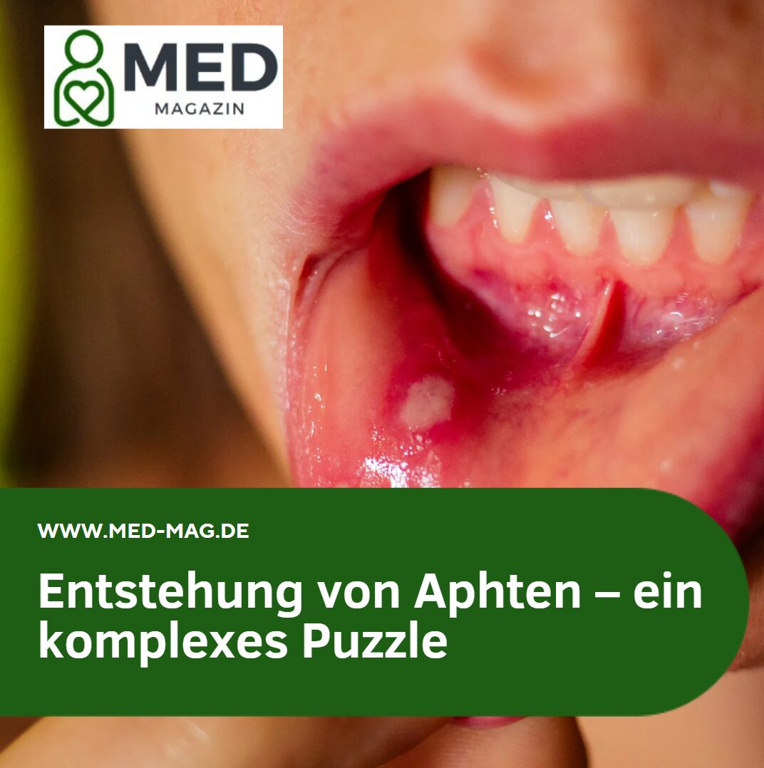 Entstehung von Aphten – ein komplexes Puzzle
