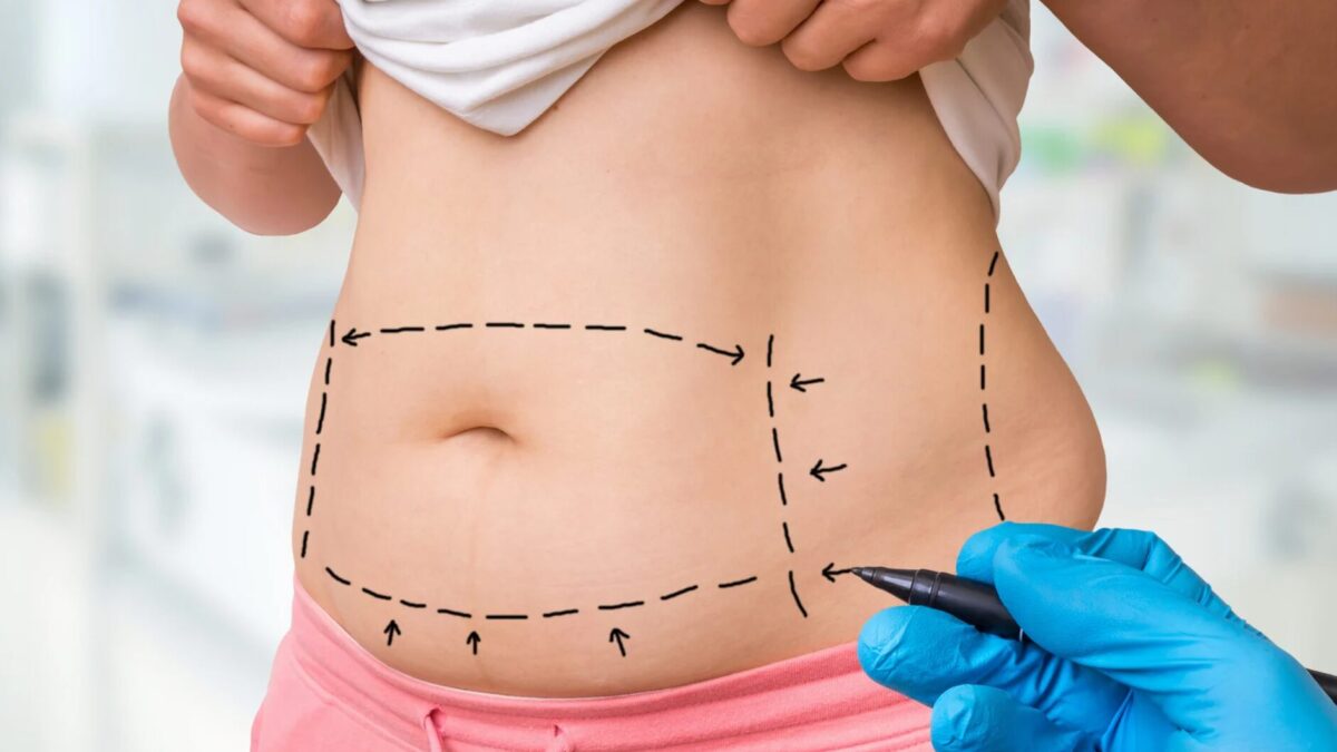 Liposuktion bei Lipödem Operative Behandlung der Fettabsaugung