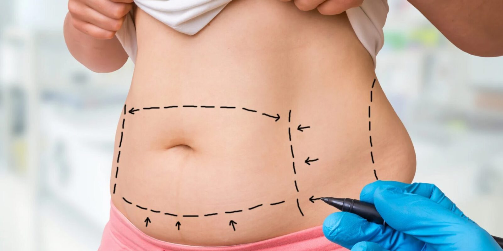 Liposuktion bei Lipödem Operative Behandlung der Fettabsaugung