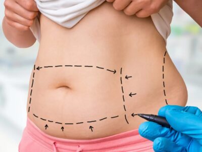 Liposuktion bei Lipödem Operative Behandlung der Fettabsaugung