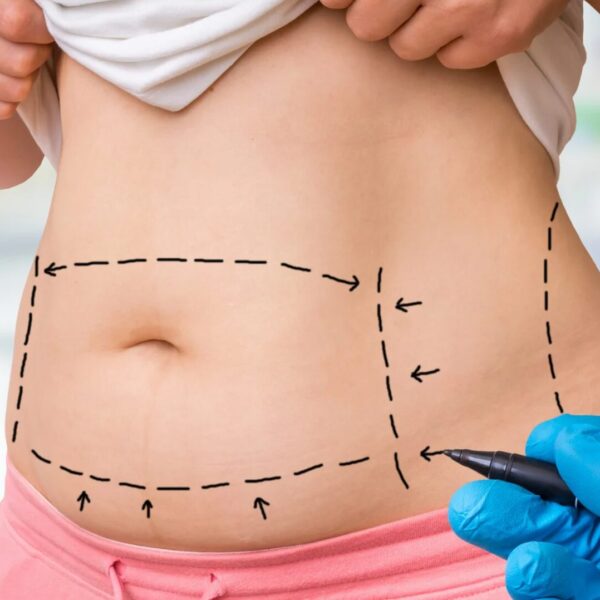 Liposuktion bei Lipödem Operative Behandlung der Fettabsaugung