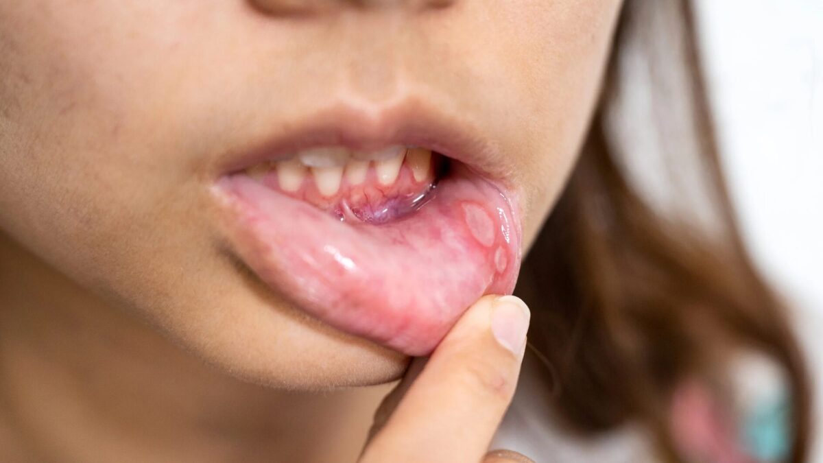 Ursache für Aphten im Mund Behandlung und Symptome