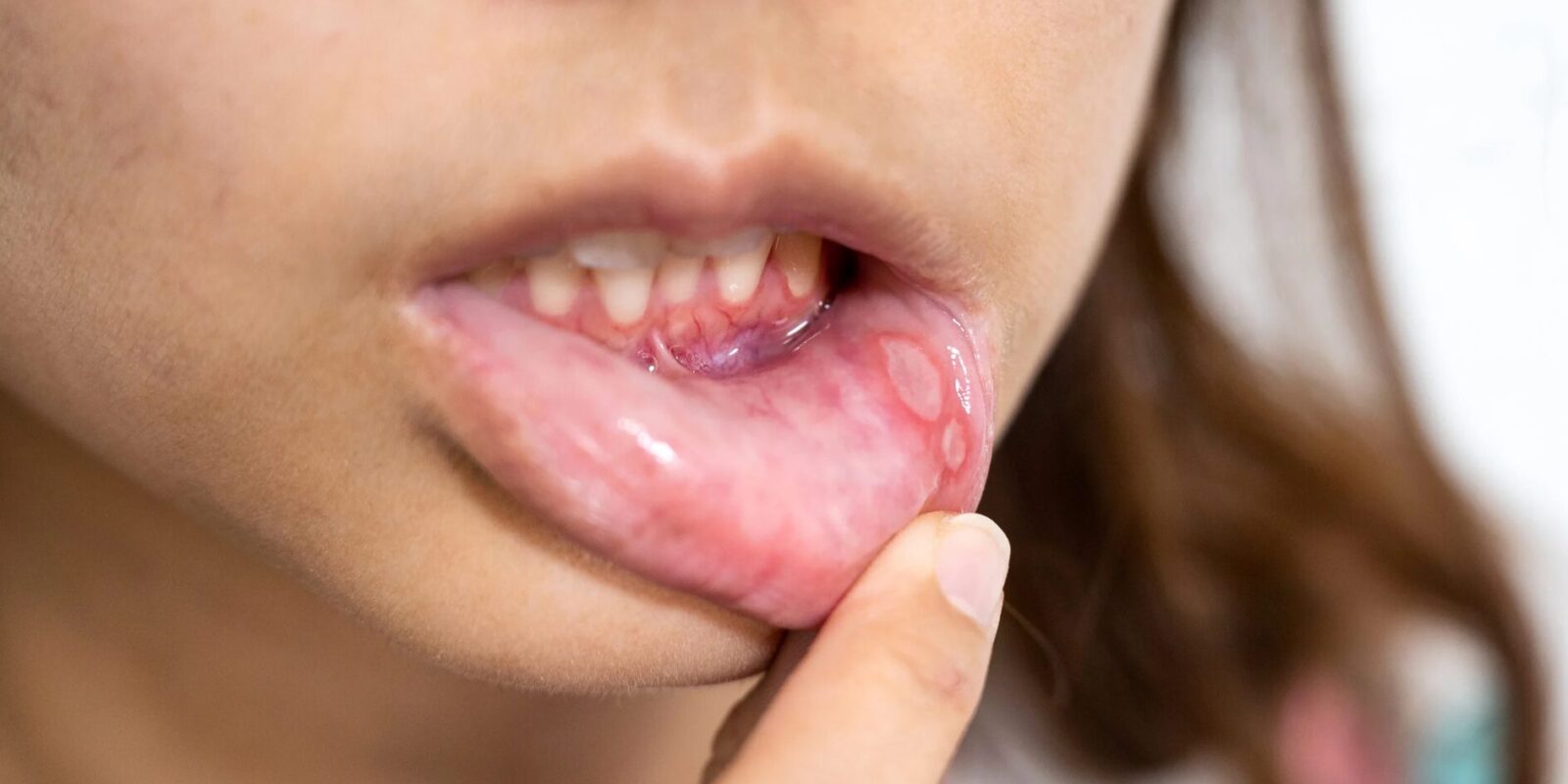 Ursache für Aphten im Mund Behandlung und Symptome