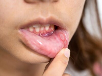 Ursache für Aphten im Mund Behandlung und Symptome