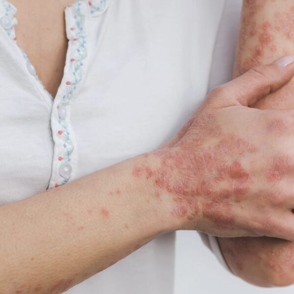 Beste Salbe gegen Schuppenflechte