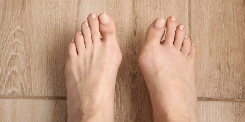 Hallux rigidus