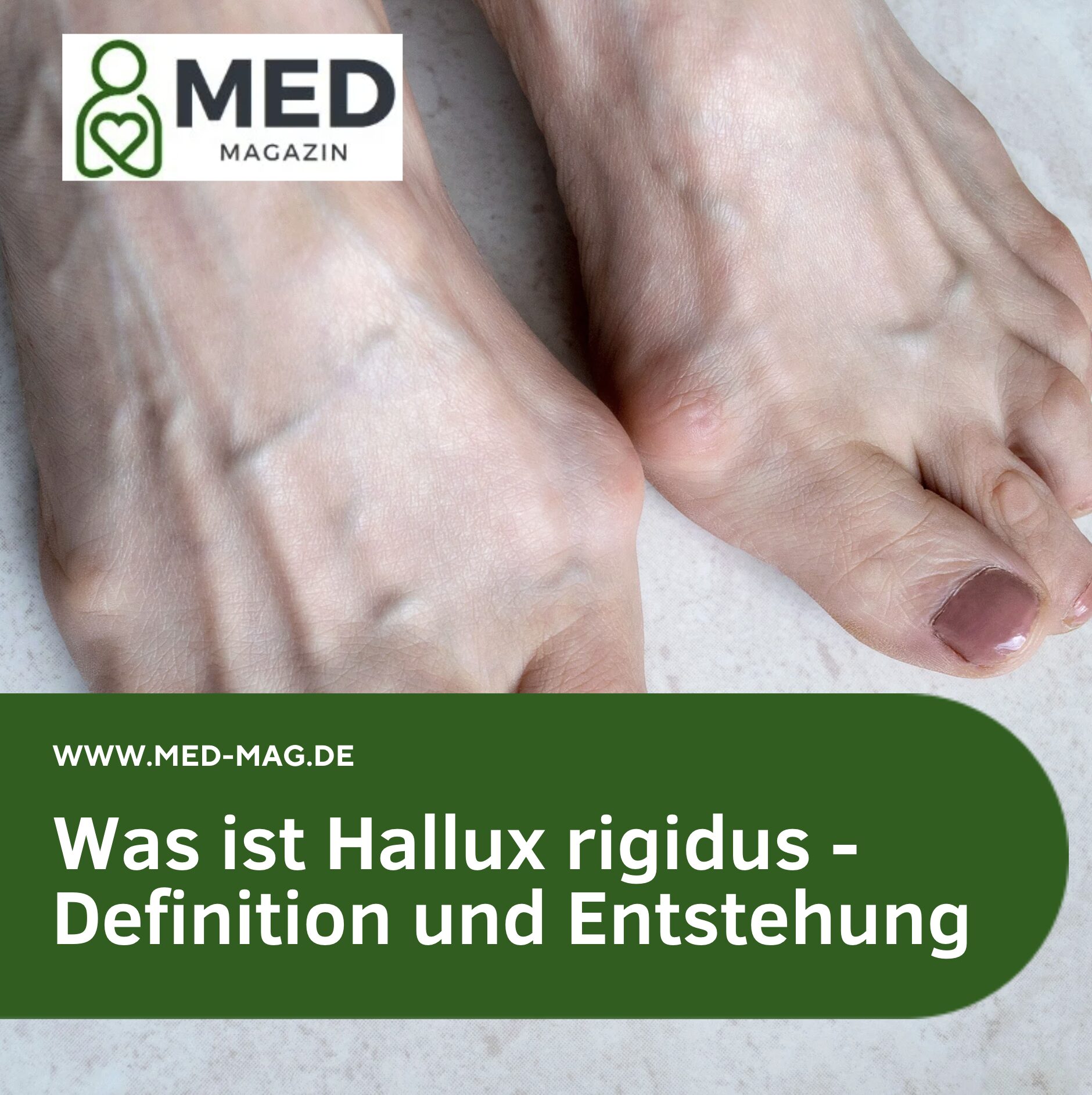 Was ist Hallux rigidus - Definition und Entstehung