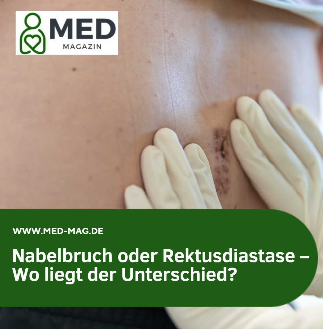 Nabelbruch oder Rektusdiastase – Wo liegt der Unterschied Nabelbruch oder Rektusdiastase – Wo liegt der Unterschied