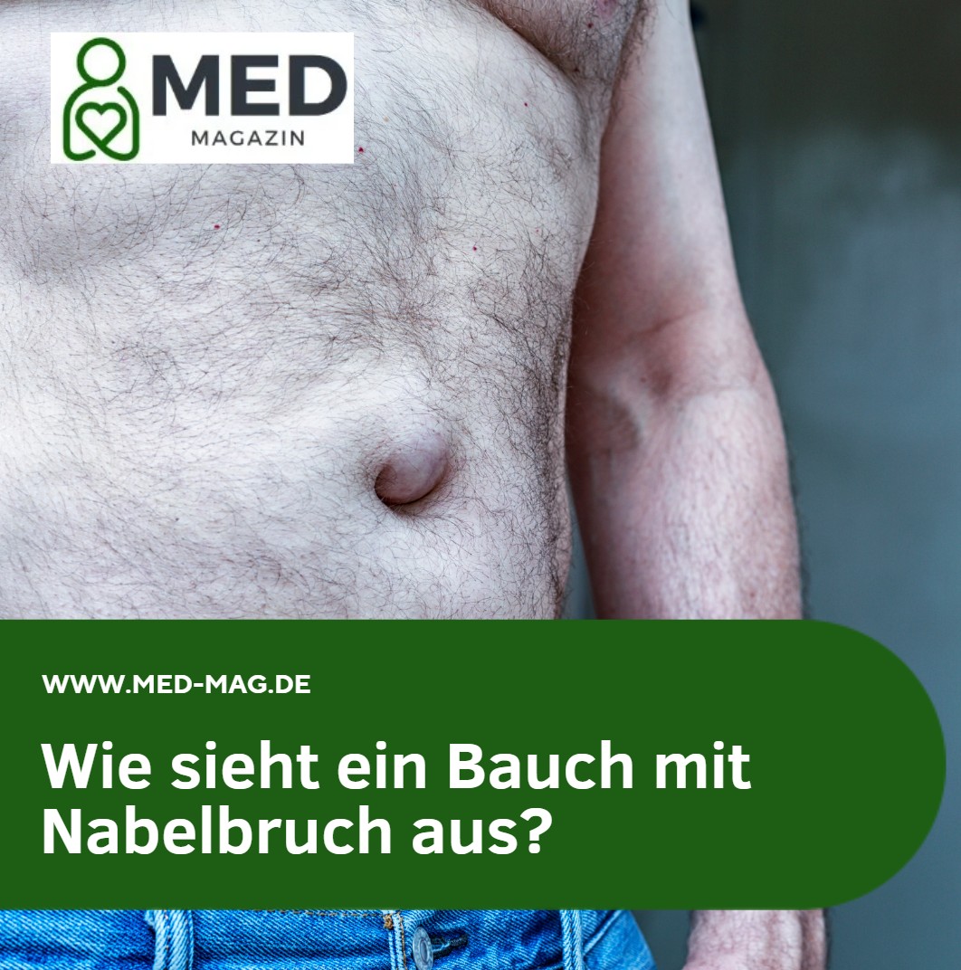 Wie sieht ein Bauch mit Nabelbruch aus Wie sieht ein Bauch mit Nabelbruch aus