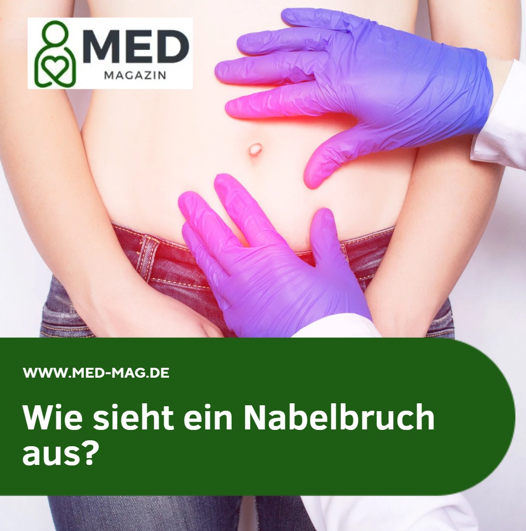 Wie sieht ein Nabelbruch aus Wie sieht ein Nabelbruch aus